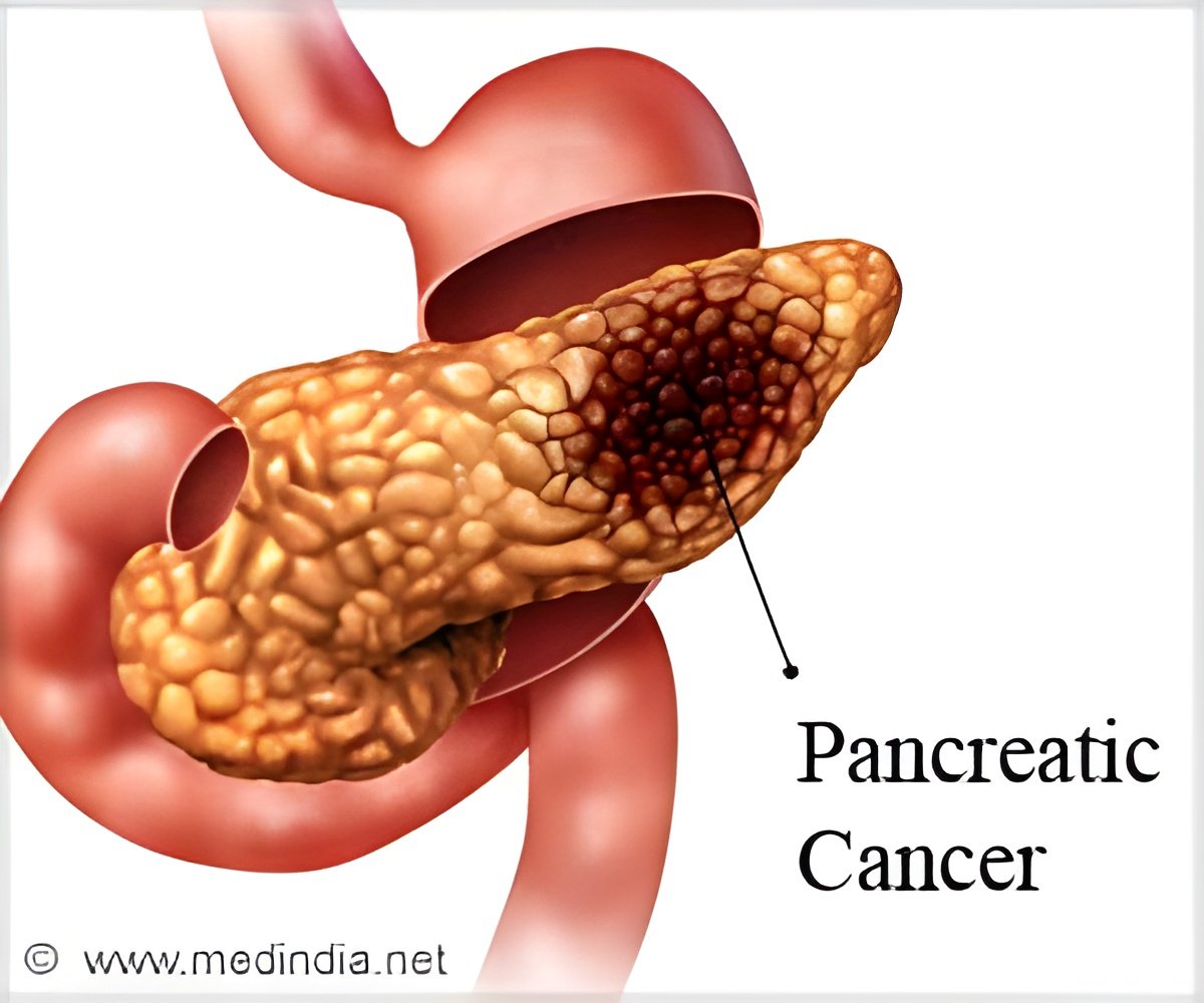 Pancreatic Cancer Doesn’t Care About Your Age